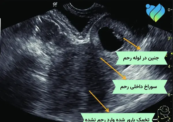 عکس سونوگرافی بارداری خارج از رحم