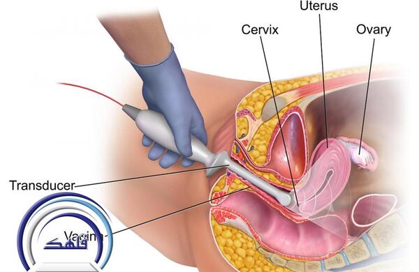 عکس سونوگرافی بارداری خارج از رحم