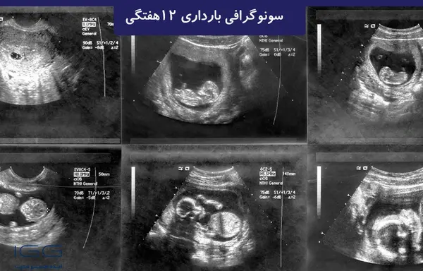 عکس سونوگرافی بارداری خارج از رحم