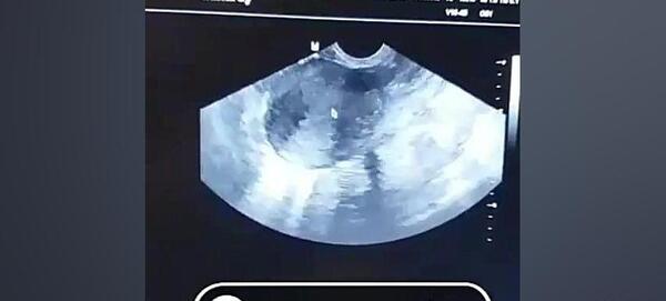 عکس سونوگرافی بارداری خارج از رحم