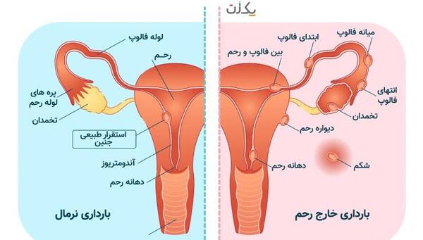شکم عکس بارداری خارج از رحم