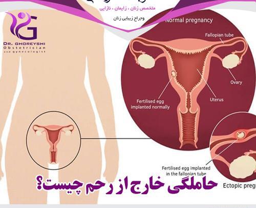 شکم عکس بارداری خارج از رحم
