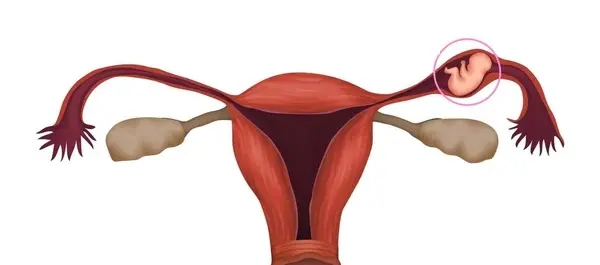 شکم عکس بارداری خارج از رحم