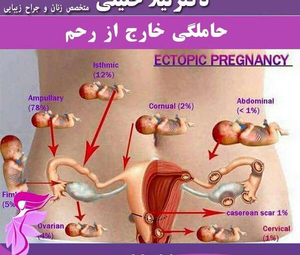 شکم عکس بارداری خارج از رحم