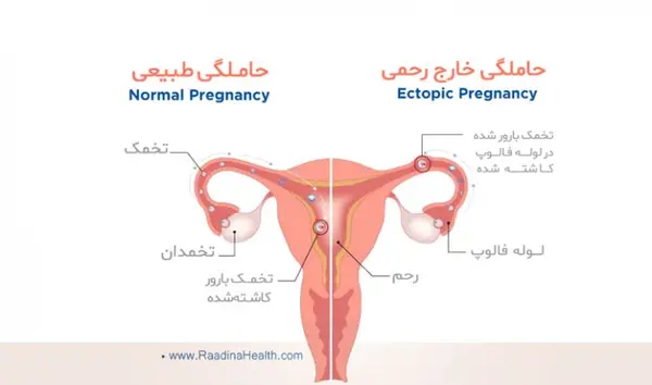 شکم عکس بارداری خارج از رحم