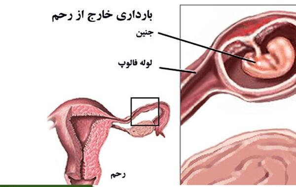 شکم عکس بارداری خارج از رحم