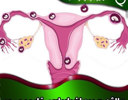 شکم عکس بارداری خارج از رحم