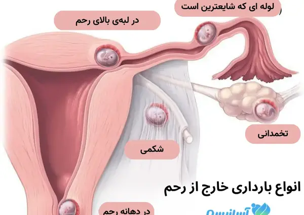 شکم عکس بارداری خارج از رحم
