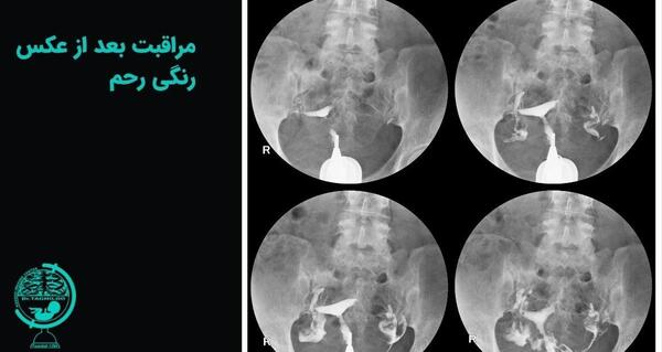 عوارض عکس رنگی رحم و بارداری