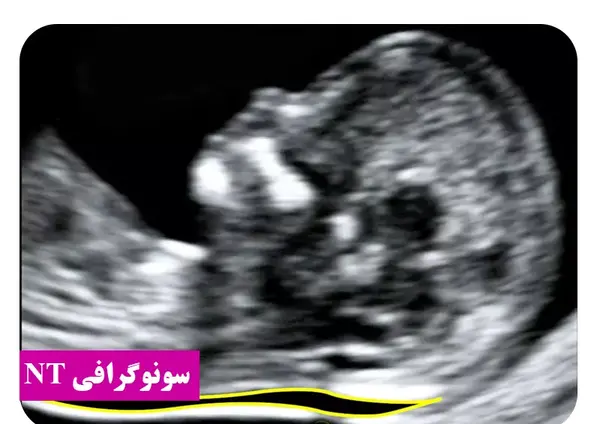 عکس سونوگرافی بارداری