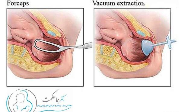 عکس بارداری طبیعی سزارین زایمان نرگس محمدی