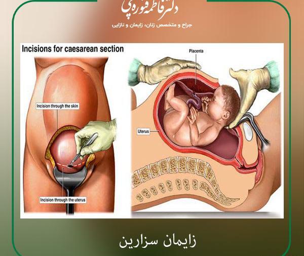 عکس عمل بارداری طبیعی