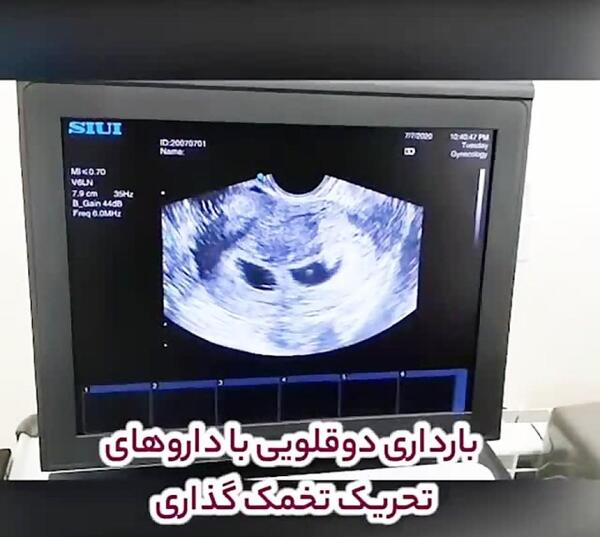 عکس سونوگرافی بارداری دوقلو