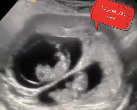 عکس سونوگرافی بارداری دوقلو
