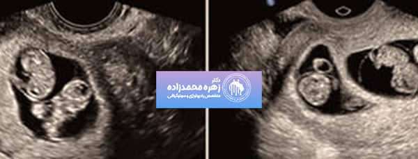 عکس سونو بارداری دوقلو