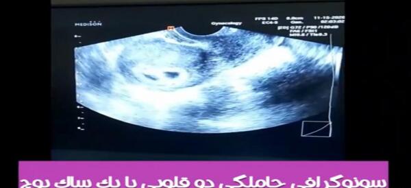 عکس سونو بارداری دوقلو
