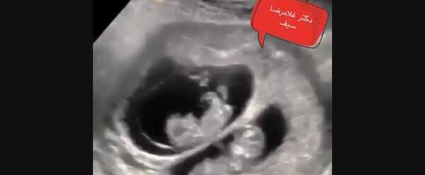 عکس سونو بارداری دوقلو