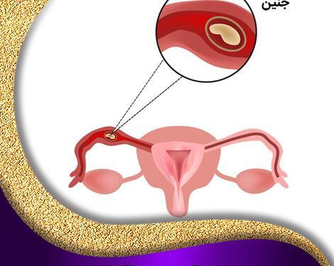 عکس سونو بارداری خارج از رحم