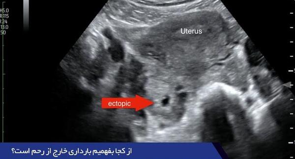 هفته هفتم عکس بارداری خارج از رحم