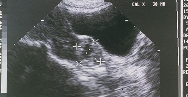 عکس رنگی بعد از بارداری خارج از رحم