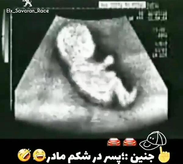 عکس شکم بارداری جنین پسر