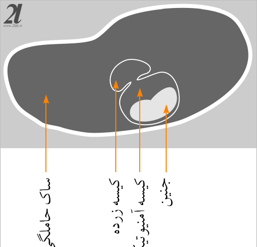 عکس سونوگرافی بارداری پوچ