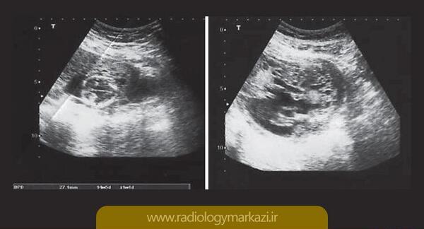 عکس سونوگرافی بارداری پوچ