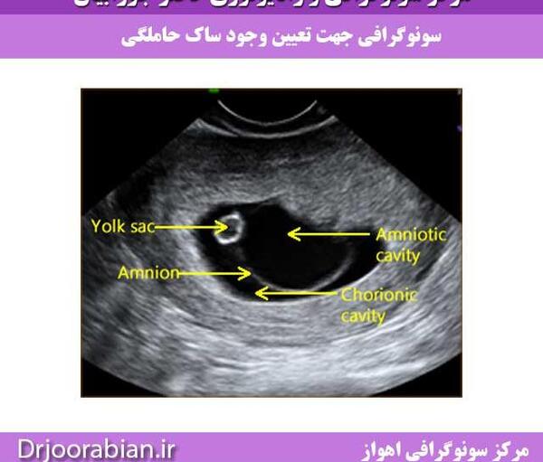 عکس سونو بارداری پوچ