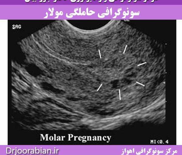 عکس سونو بارداری پوچ