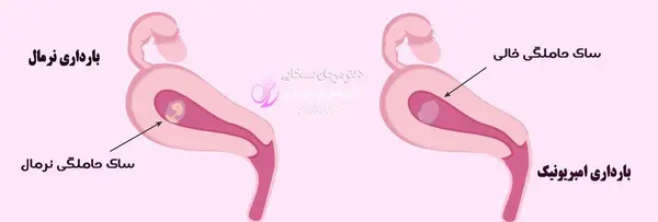 عکس سونو بارداری پوچ