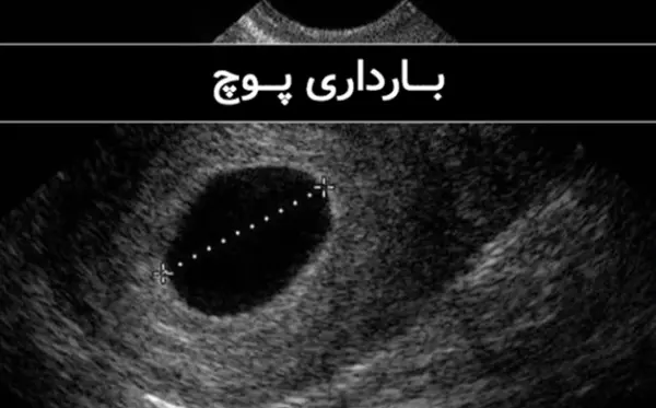 عکس سونو بارداری پوچ