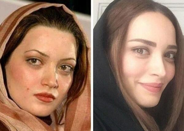 عکس قبل از عمل طلا گلزار