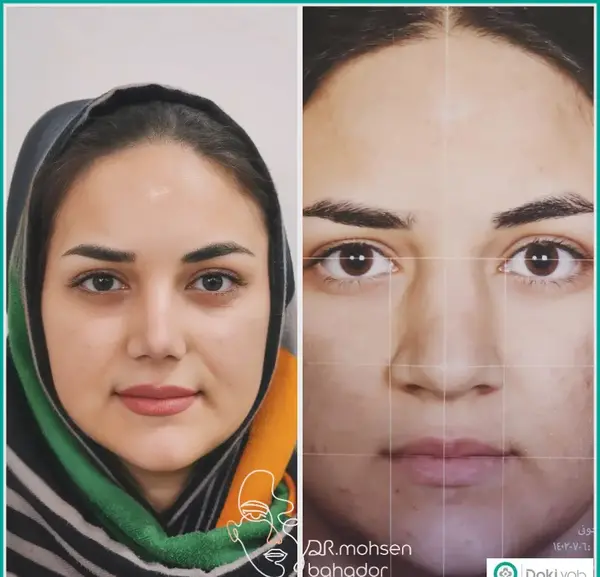 عکس محسن یگانه قبل و بعد از عمل بینی