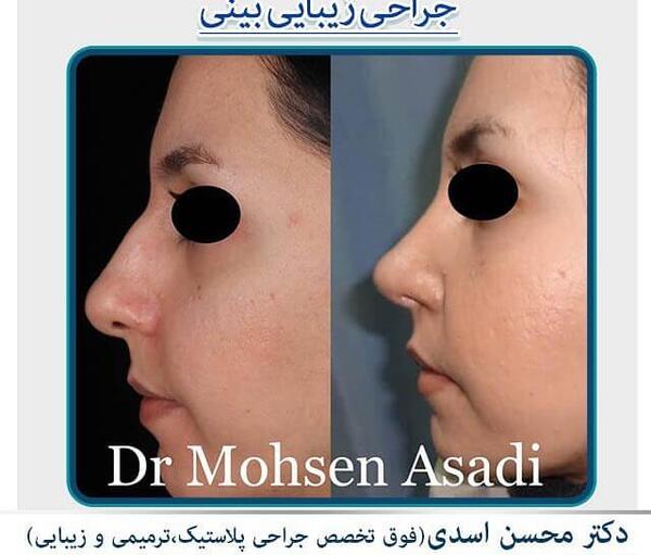 عکس محسن یگانه قبل و بعد از عمل بینی