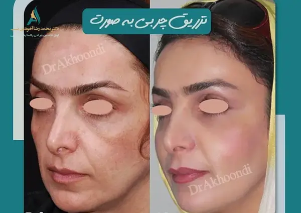 عکس های قبل و بعد تزریق چربی