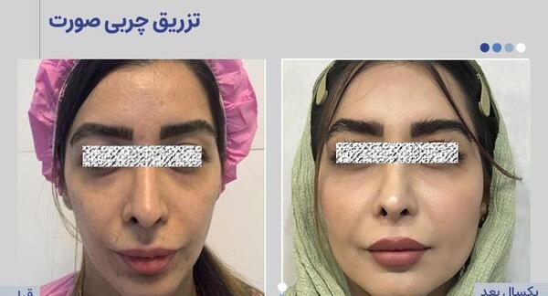 عکس های قبل و بعد تزریق چربی