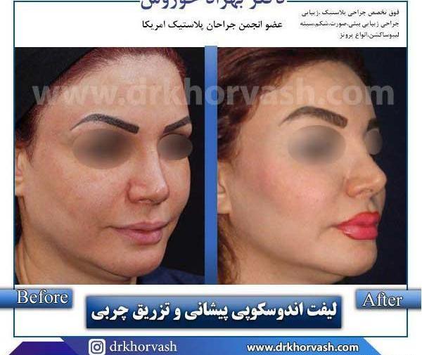 عکس های قبل و بعد تزریق چربی