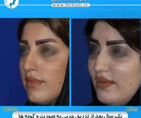 عکس های قبل و بعد تزریق چربی