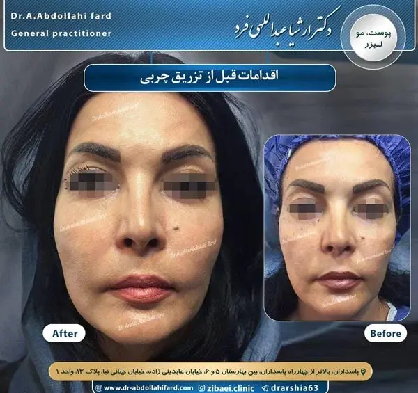 عکس های قبل و بعد تزریق چربی