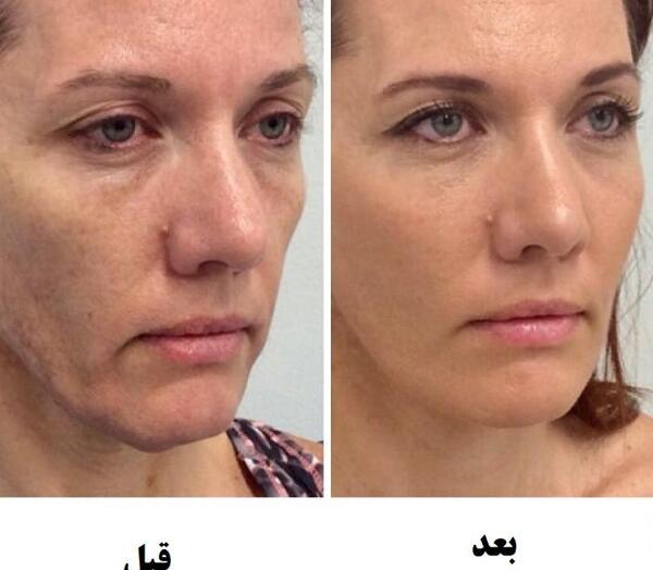 عکس های قبل و بعد تزریق چربی