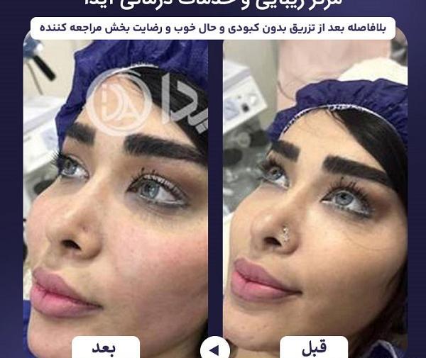 عکسهای قبل و بعد از تزریق چربی صورت