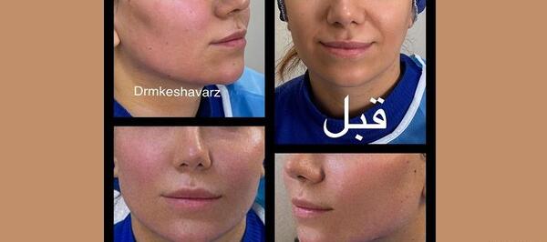 عکسهای قبل و بعد از تزریق چربی صورت