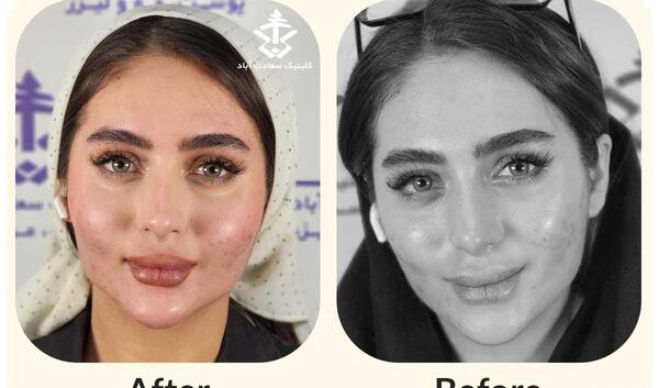 عکسهای قبل و بعد از تزریق چربی صورت