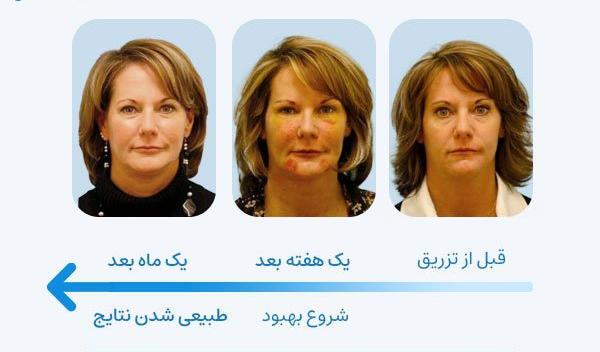 عکسهای قبل و بعد از تزریق چربی صورت