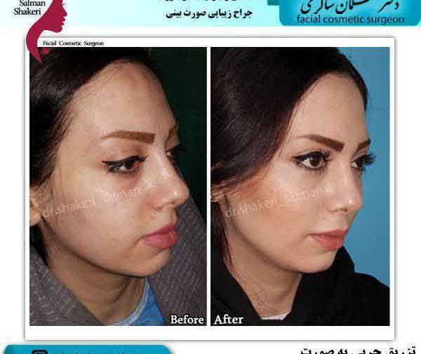عکسهای قبل و بعد از تزریق چربی صورت