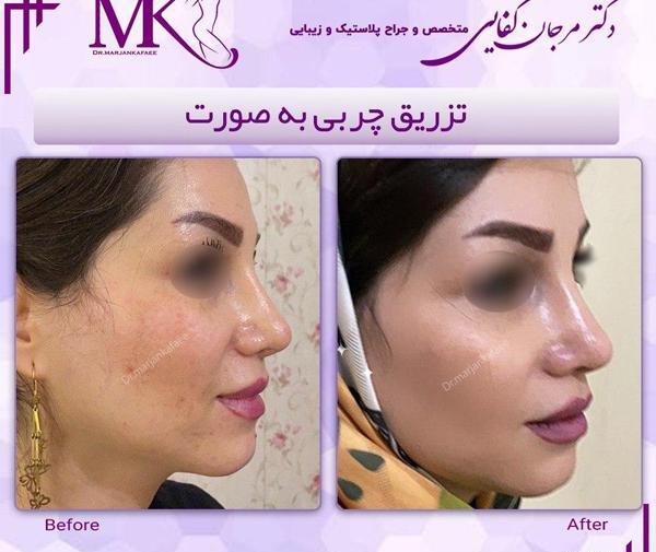 عکسهای قبل و بعد از تزریق چربی صورت