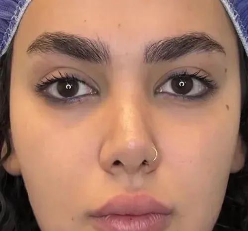 عکسهای قبل و بعد از تزریق چربی صورت