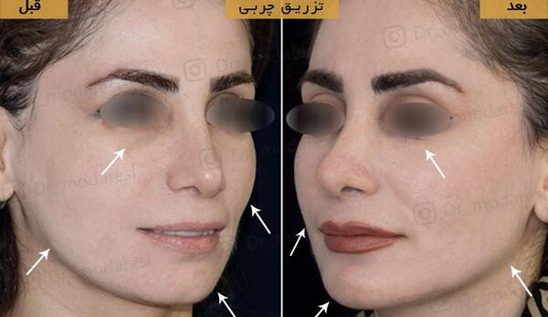 عکسهای قبل و بعد از تزریق چربی صورت