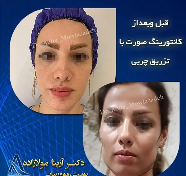 عکسهای قبل و بعد از تزریق چربی صورت