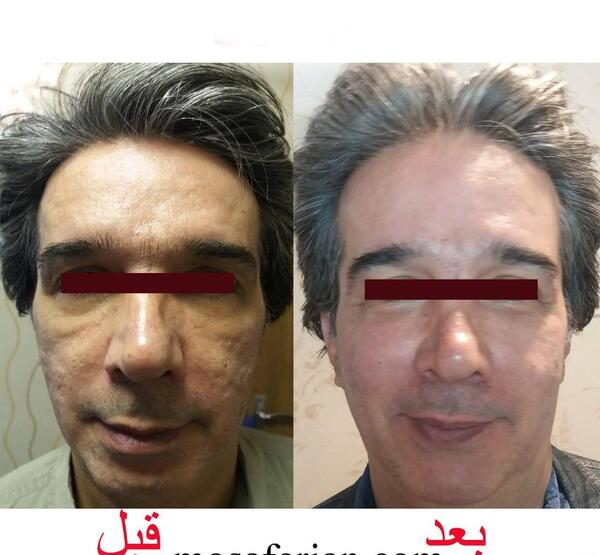 عکسهای قبل و بعد از تزریق چربی صورت